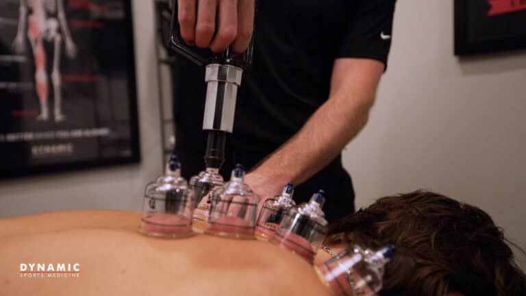 Cupping therapy being applied to an athlete's back for pain relief and muscle recovery at a sports medicine clinic.