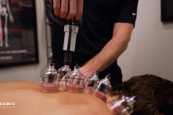 Cupping therapy being applied to an athlete's back to enhance recovery and reduce soreness, showcasing innovative sports medicine techniques.