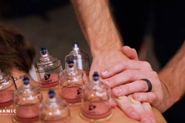 Cupping therapy session demonstrating suction cups on a patient's back for pain relief and muscle recovery.
