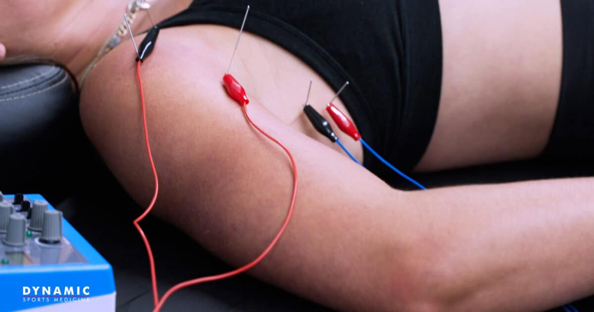 Dry Needling for Muscle Pain, Recovery, and Performance: A Complete Guide