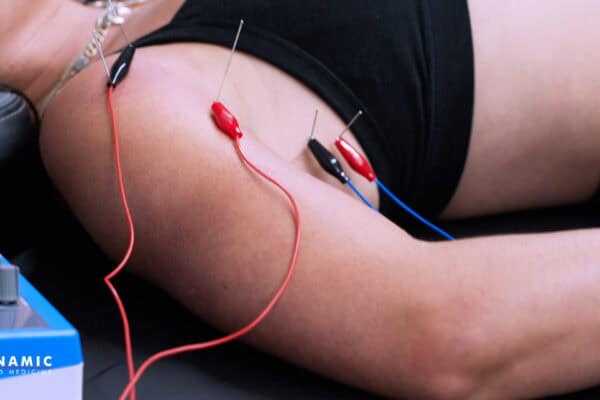 Close-up of dry needling treatment on a patient's shoulder for pain relief at Dynamic Sports Medicine clinic.