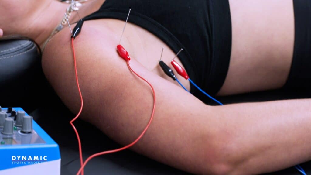 Electrotherapy treatment for muscle recovery and pain relief at Dynamic Sports Medicine.